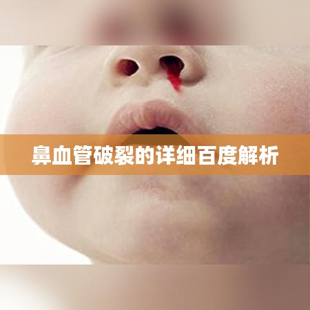 鼻血管破裂的详细百度解析